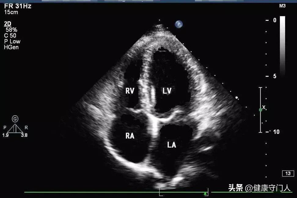心电图检查_心率正常值_正常人的收缩压是多少?