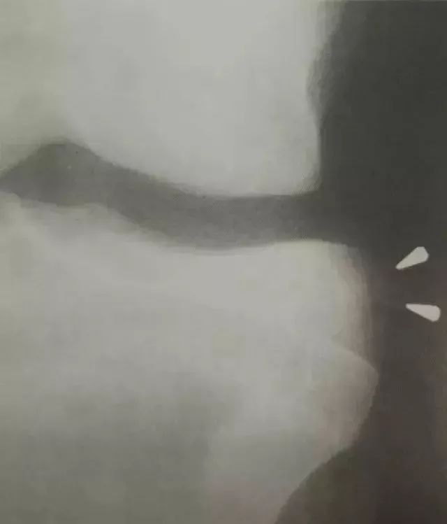 交叉韧带运动康复_交叉韧带康复科一天多少钱_前交叉韧带康复训练图