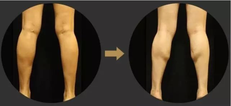 瘦小腿不同类型针对性训练_瘦腿操下载_判断肌肉腿脂肪腿水肿腿