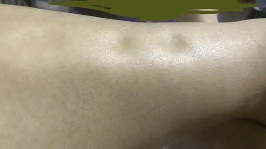 瘦腿操下载_瘦小腿不同类型针对性训练_判断肌肉腿脂肪腿水肿腿