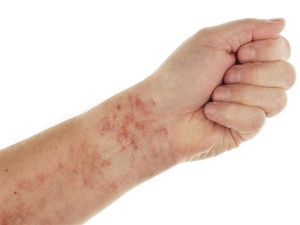 pg电子麻将胡了入口下载 手臂上小红点不痛不痒怎么回事