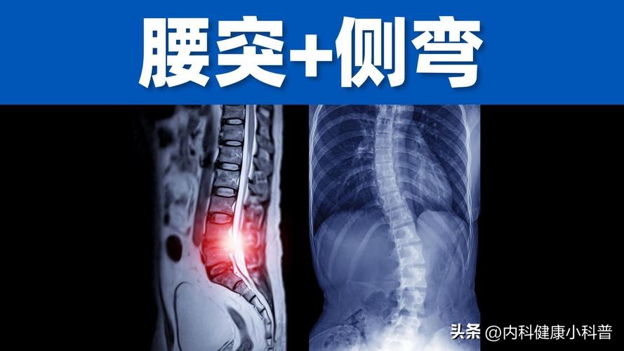 腰椎间盘突出 避免动作 康复锻炼_腰椎间盘突出不能弯腰