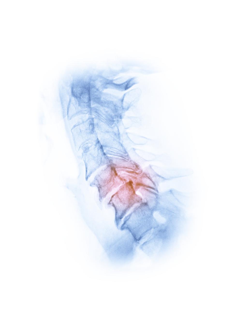 腰椎间盘突出不能弯腰_腰椎间盘突出坏习惯_久坐不动腰伤