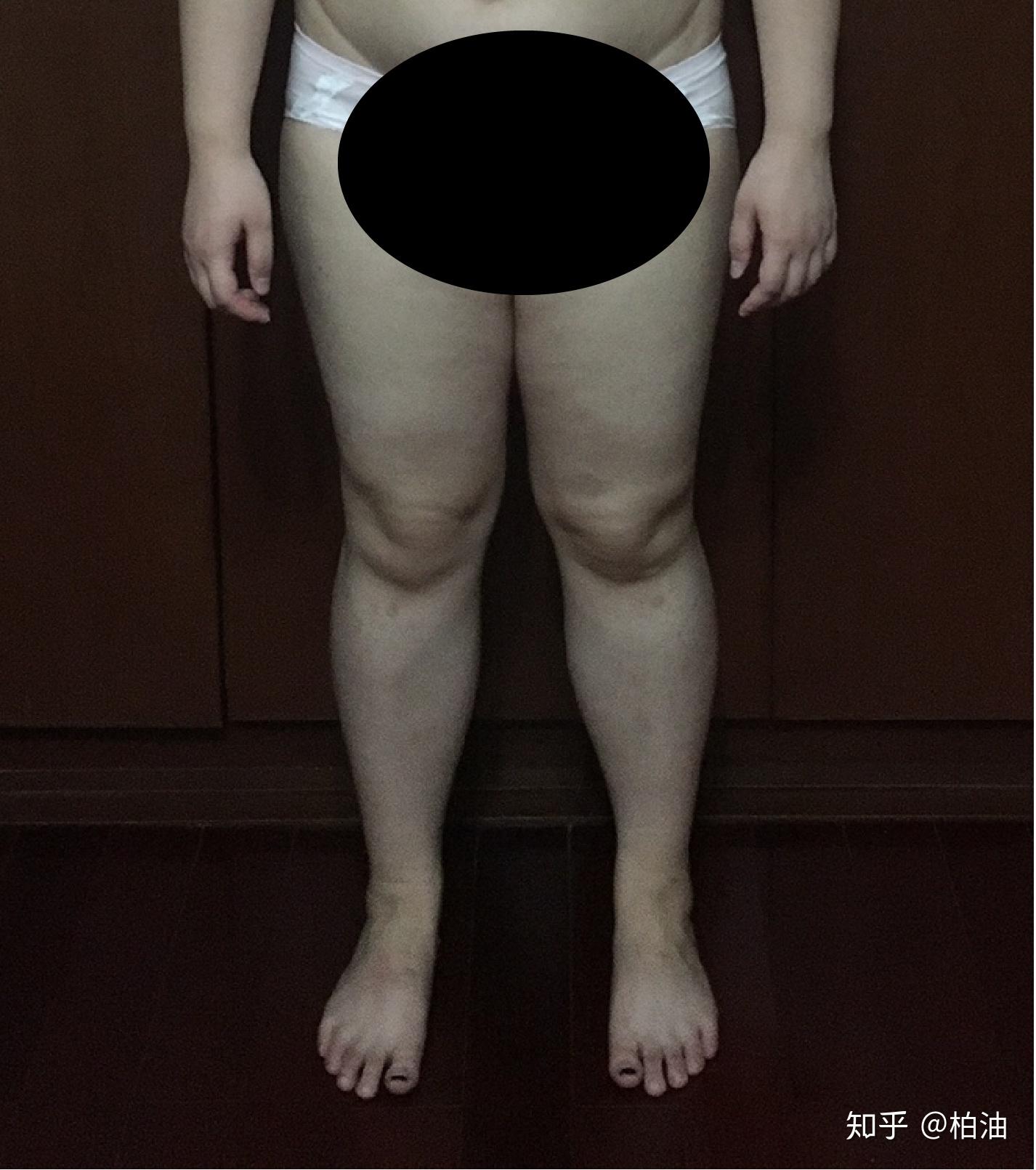 腿向后踢屁股有什坏处_X型腿O型腿区别_腿型分析