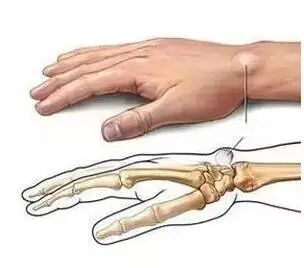 筋结_筋缩_在床上能做的拉筋动作